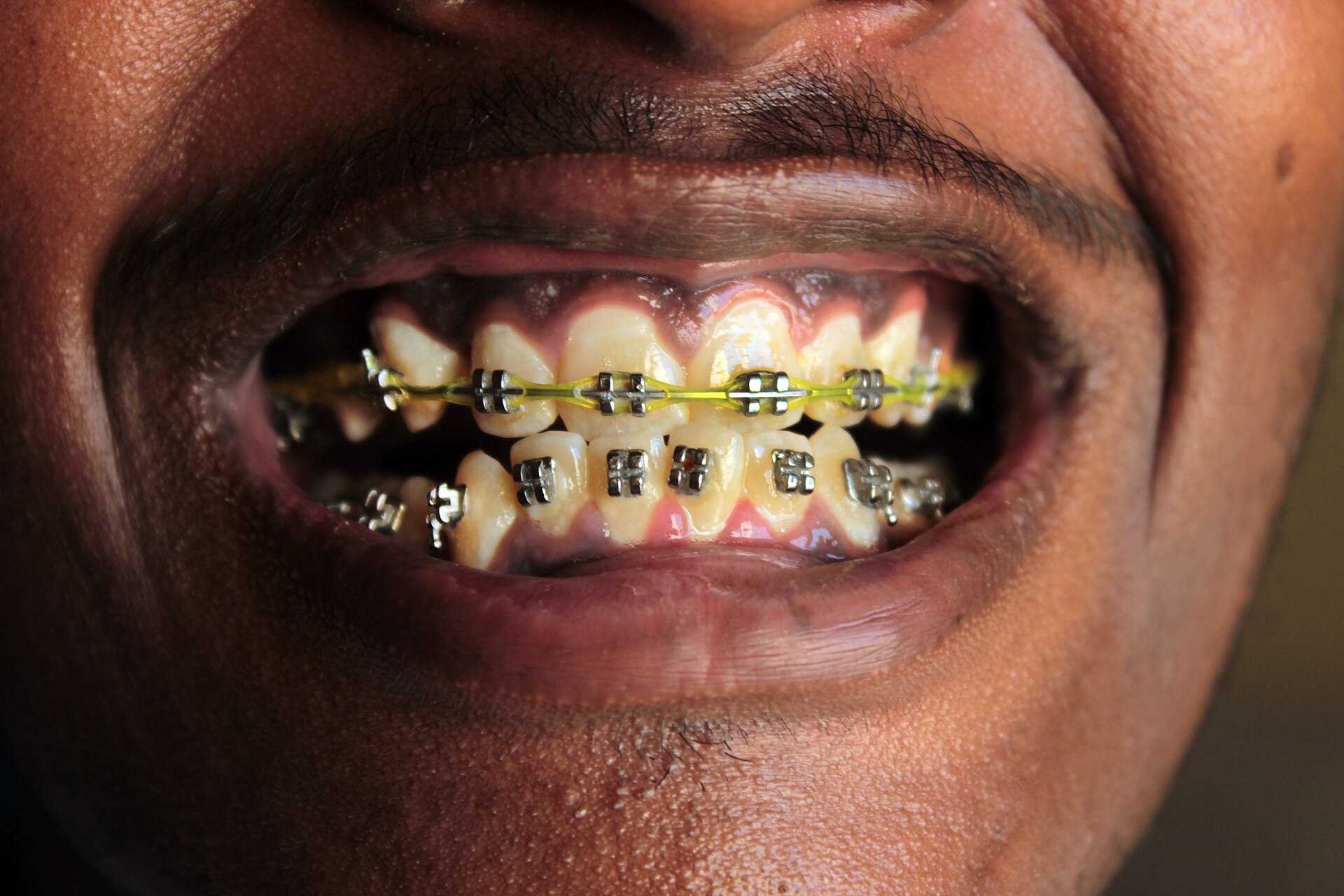 Close-up of teeth braces