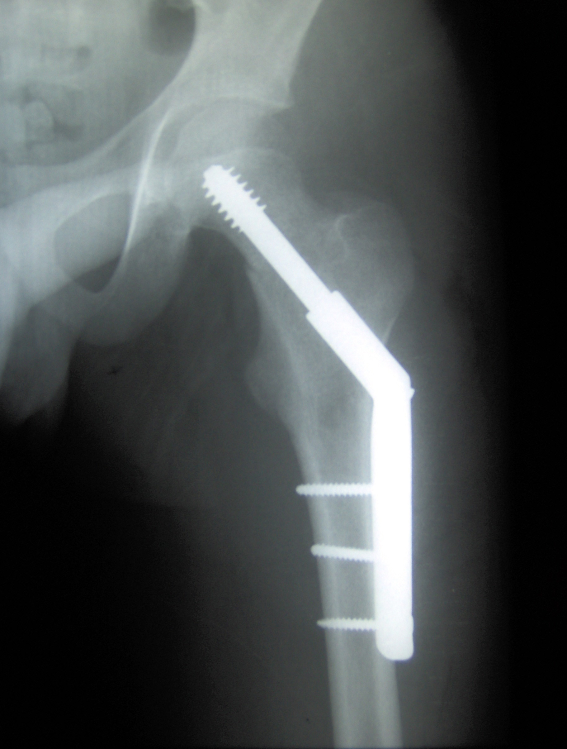 Dynamic Hip Screw implant X-ray