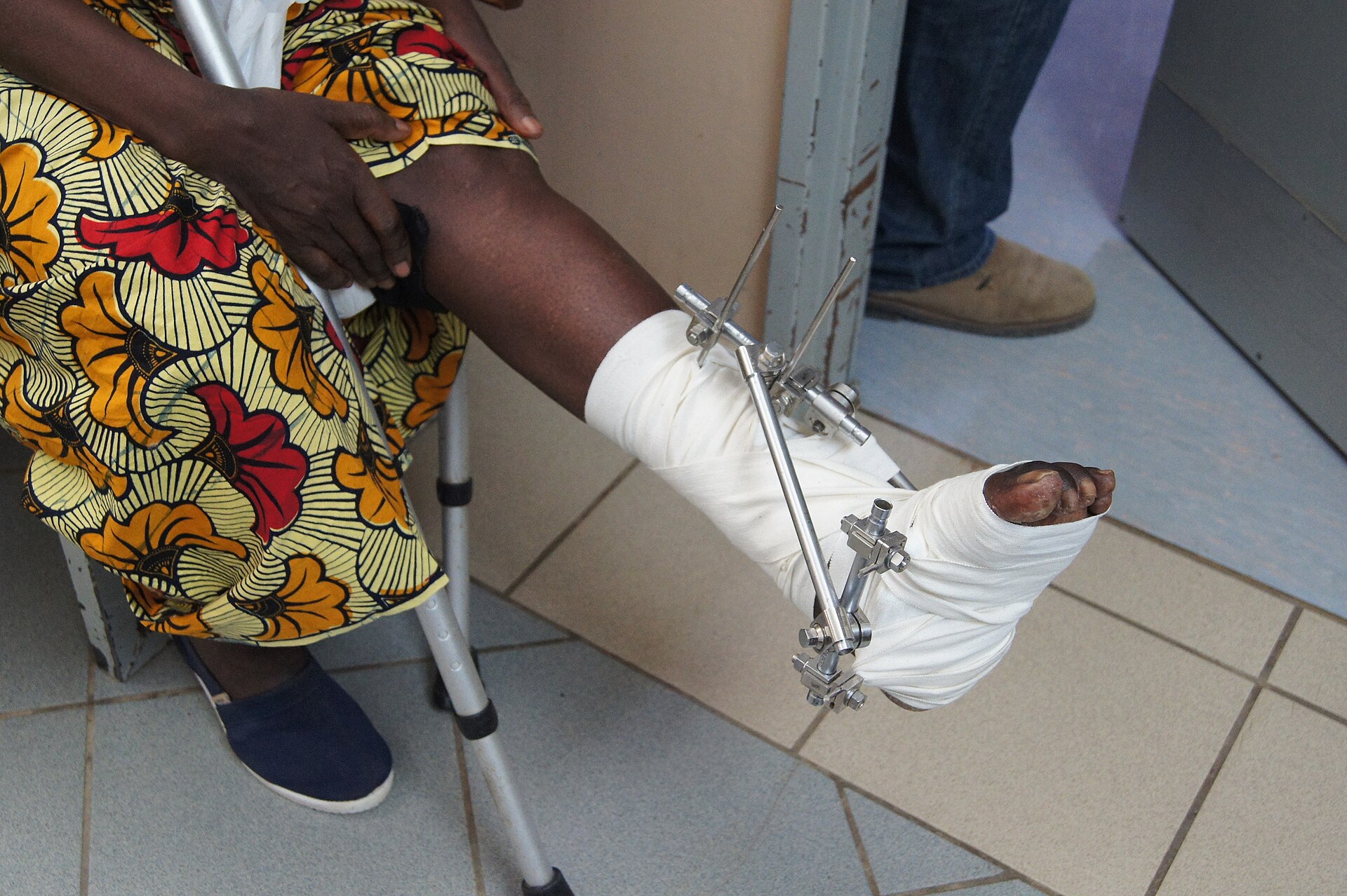 External fixator on a patient