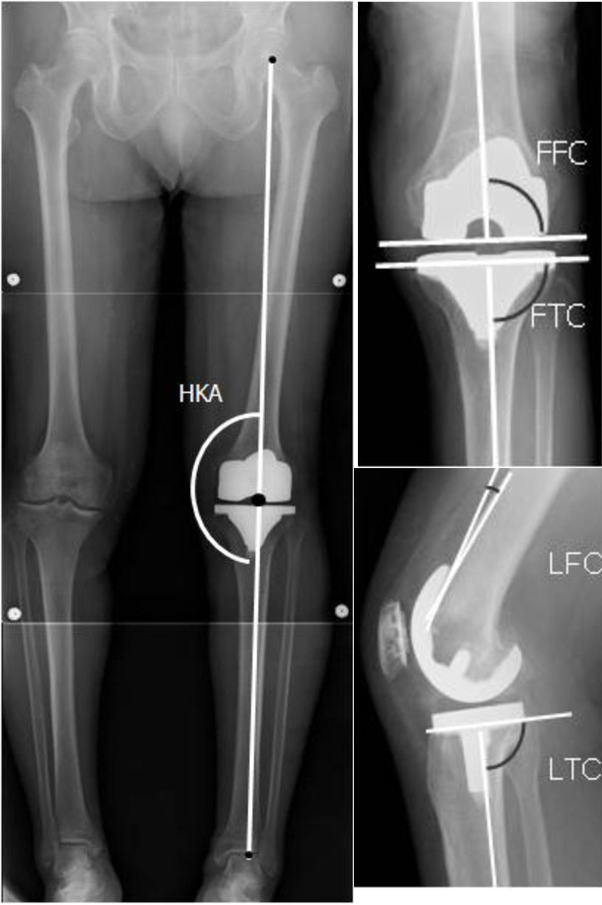Knee replacement implant X-ray